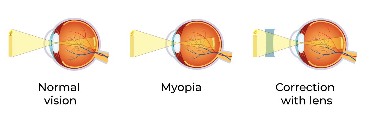 myopia symptoms